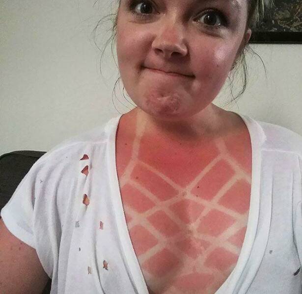 When Sunbathing Goes Wrong…