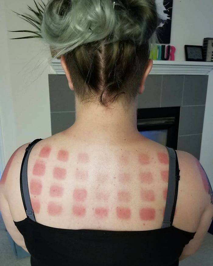 When Sunbathing Goes Wrong…