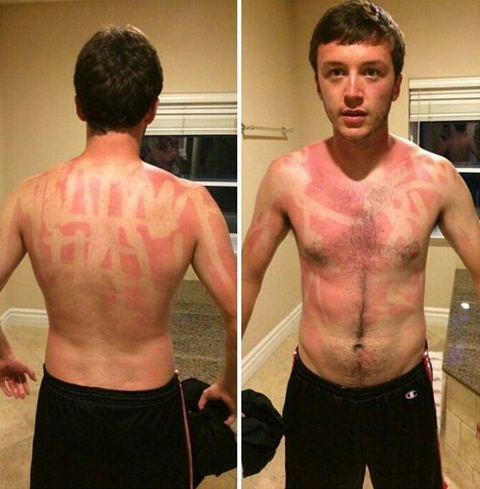 When Sunbathing Goes Wrong…