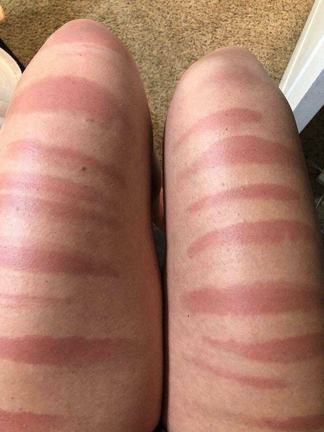 When Sunbathing Goes Wrong…