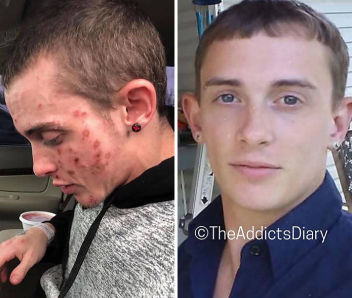 How Drug Addiction Looks Before And After