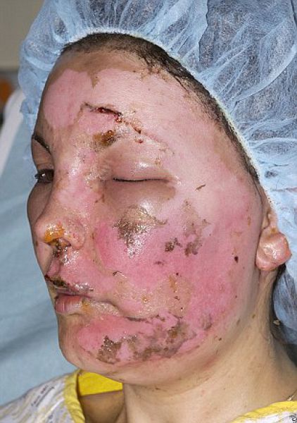 Incredible Healing after a Bomb Explosion (15 pics) Incredible Healing after a Bomb Explosion (15 pics)
